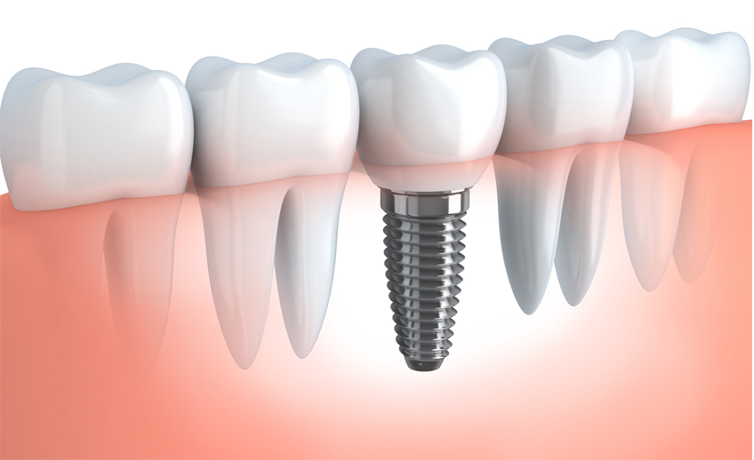 Best dental implant treatment in sikar