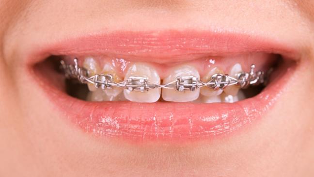 Best orthodontics treatments in sikar